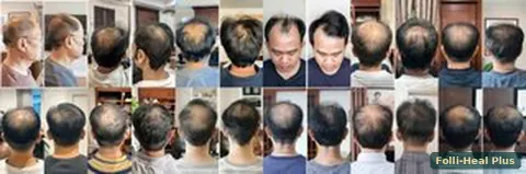 Before and after collage of Folli-Heal Plus clients